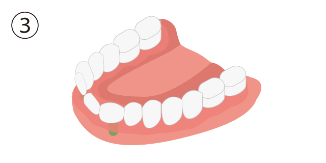 香里園レジデンス歯科のインプラント治療「ALL-on-4」の説明画像