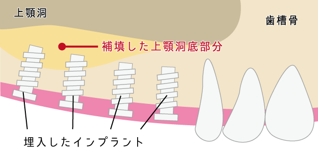 香里園レジデンス歯科のインプラント治療「サイナスリフト」の説明画像