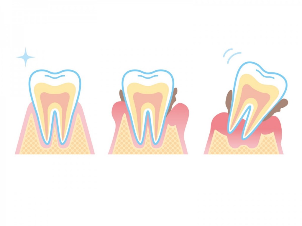 歯周病とインプラントの関係